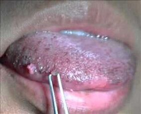 혀의 인유두종바이러스